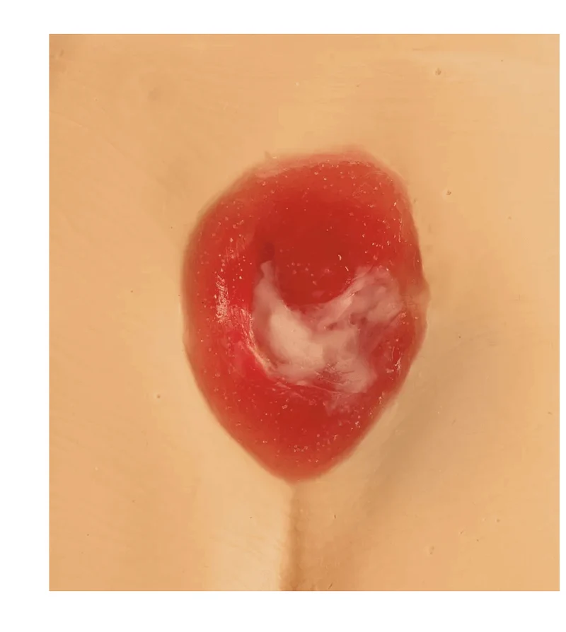 Druckgeschwür / Dekubitus Modelle