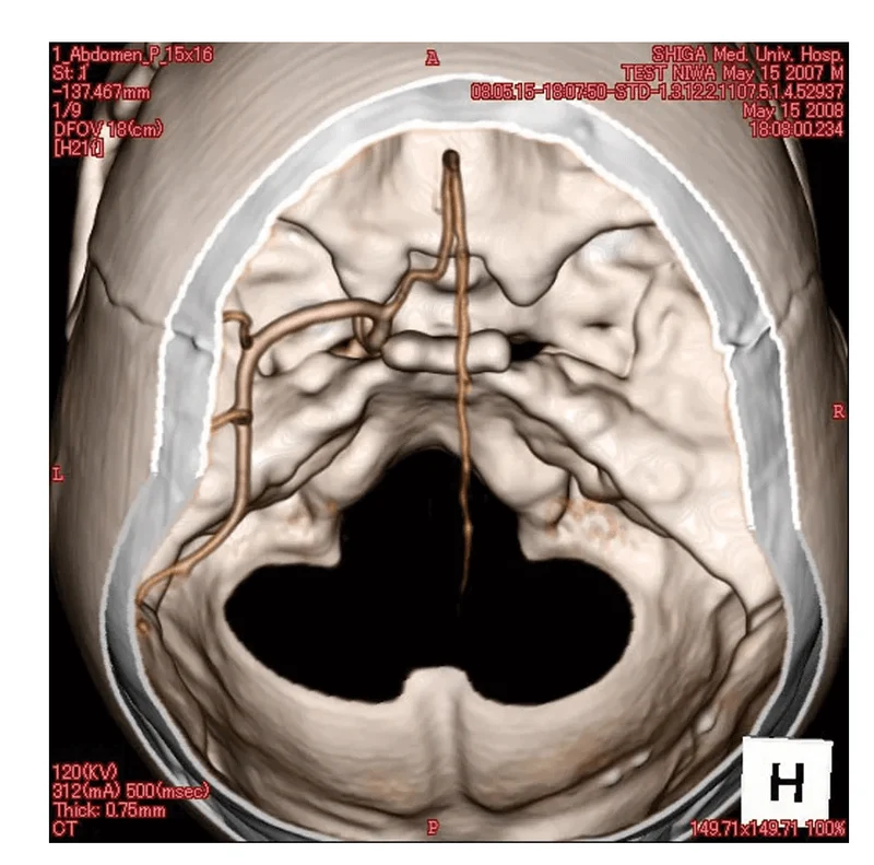 Angiographie Kopfmodell