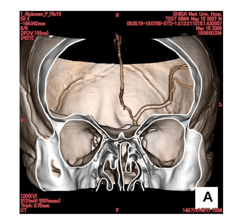 Angiographie Kopfmodell