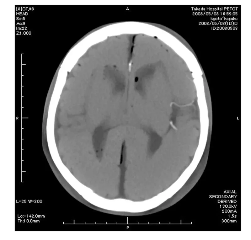 Angiographie Kopfmodell