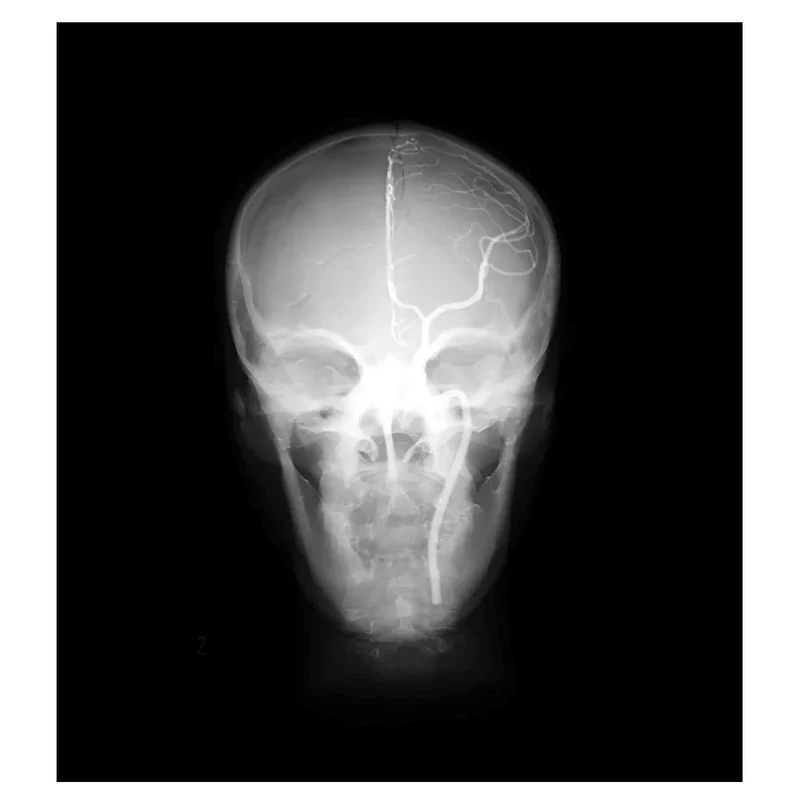 Angiographie Kopfmodell