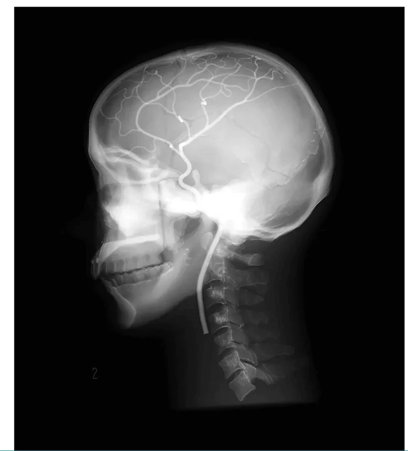 Angiographie Kopfmodell