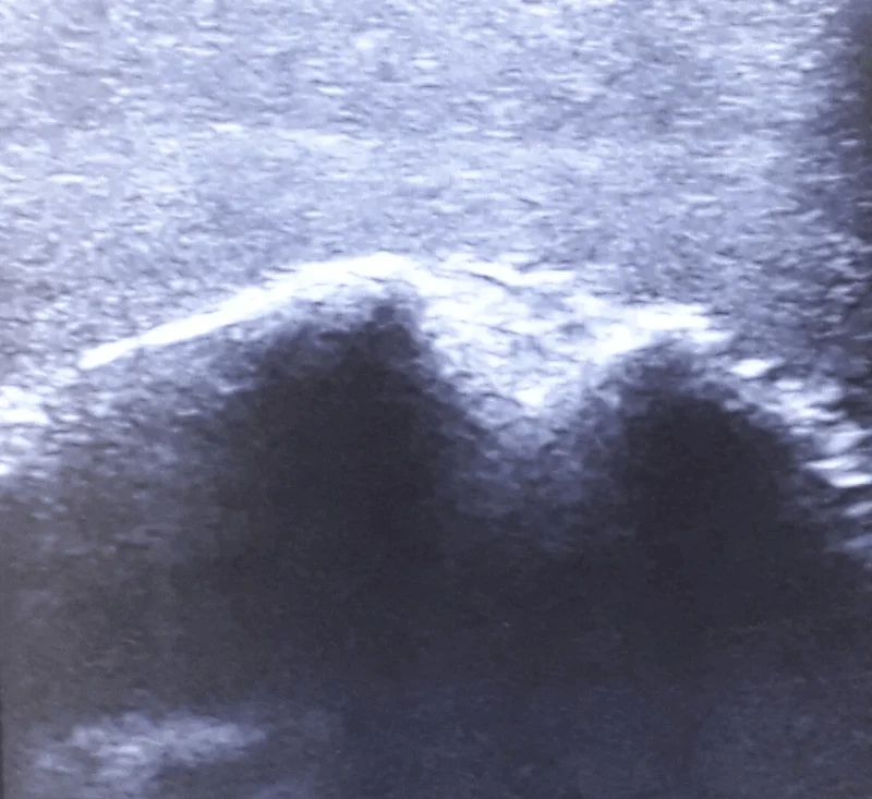 Ultraschall Schultermodell für Punktionstraining