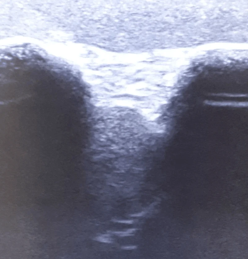 Ultraschall Schultermodell für Punktionstraining