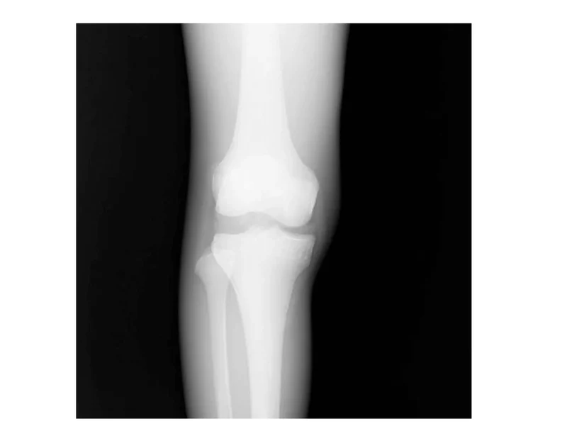 CT Knie Bänder Phantom