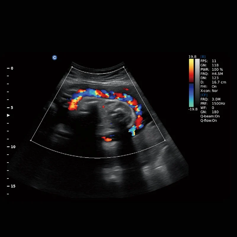 CHISON EBit 30 inkl. Ultraschallwagen