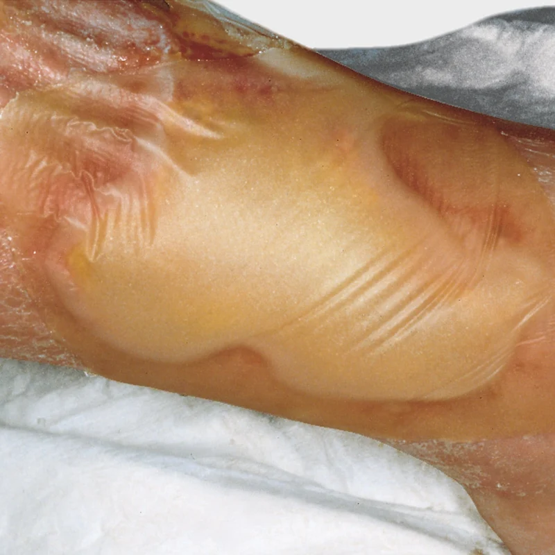 Hydrocoll Hydrokolloid-Verband