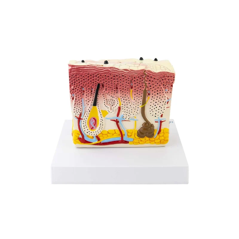 Hautmodell mit Psoriasis