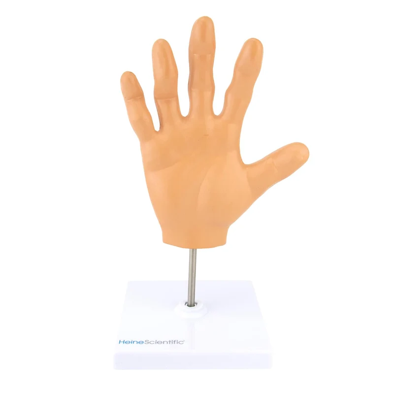 Handmodell mit rheumatoider Arthritis