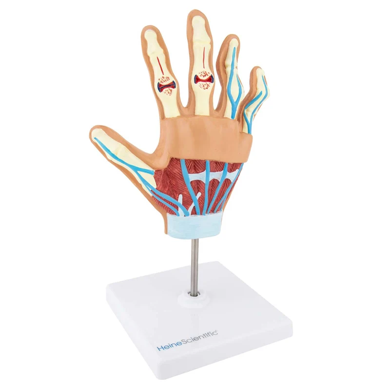 Handmodell mit rheumatoider Arthritis
