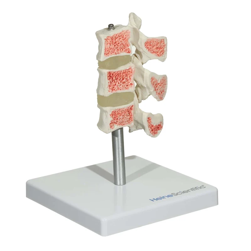 Osteoporose Modell