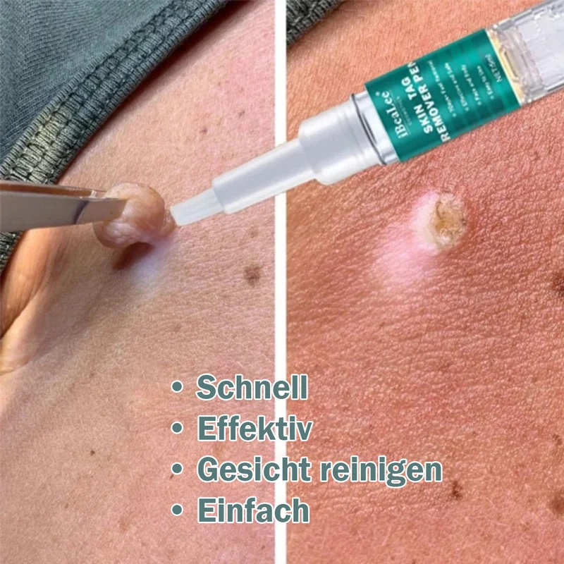 Hautanhängsel Entferner - Natürliche Lösung für Warzen und Muttermale