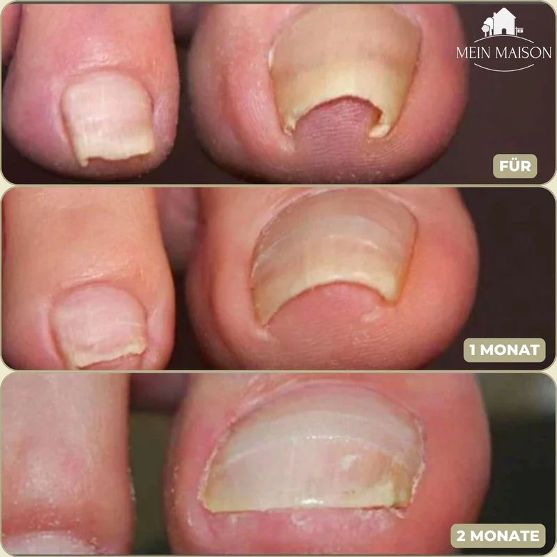 FixaNail | Innovatives Nagelkorrektursystem für gesunde Nägel