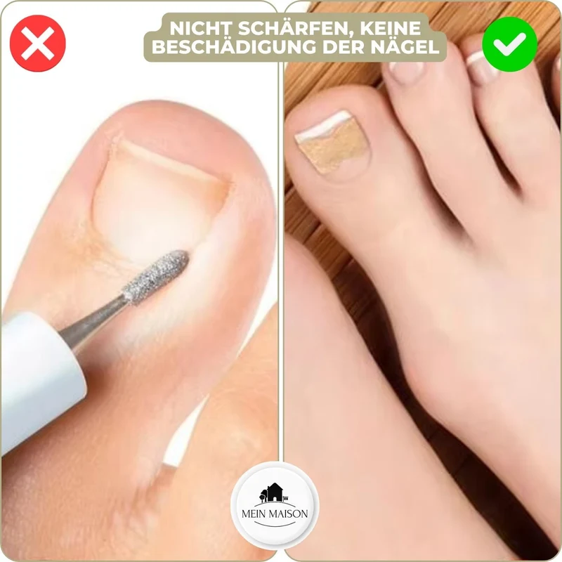 FixaNail | Innovatives Nagelkorrektursystem für gesunde Nägel