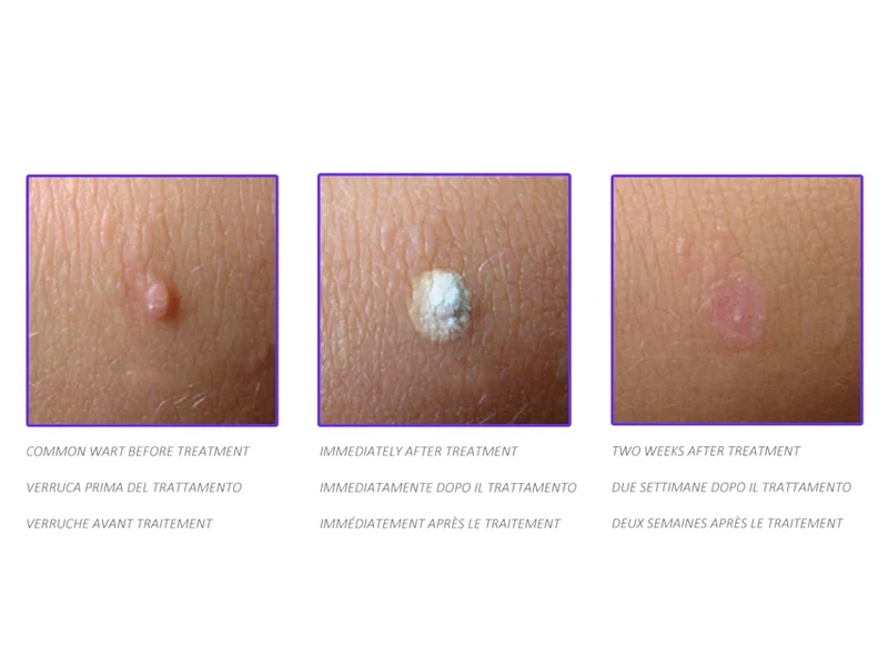 CryOmega, Cryotherapie met 16 gram cartridge, alternatief voor stikstof