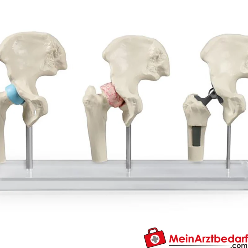 Erler-Zimmer Hüftmodell 3-teilig, beweglich mit entnehmbarem Implantat und Plexiglas-Stativ
