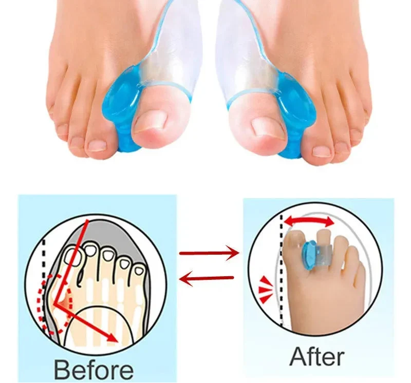 Silikon Gel Zehenspreizer – Weiche, Wiederverwendbare Hallux-Valgus-Korrektur für Schmerzfreie Zehenausrichtung