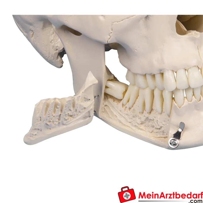 Erler-Zimmer Dental-Schädel 4-teilig – 31 teilbare Zähne, abnehmbarer Unterkiefer, 22 x 13 x 17 cm