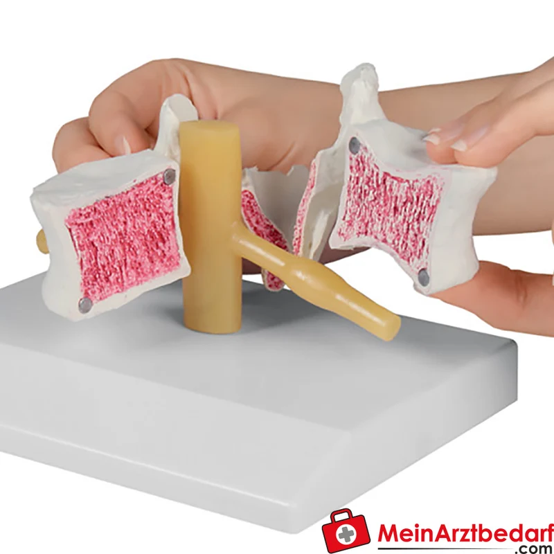 Erler-Zimmer Lendenwirbel-Modell Osteoporose 3-teilig magnetisch abnehmbar 16 cm