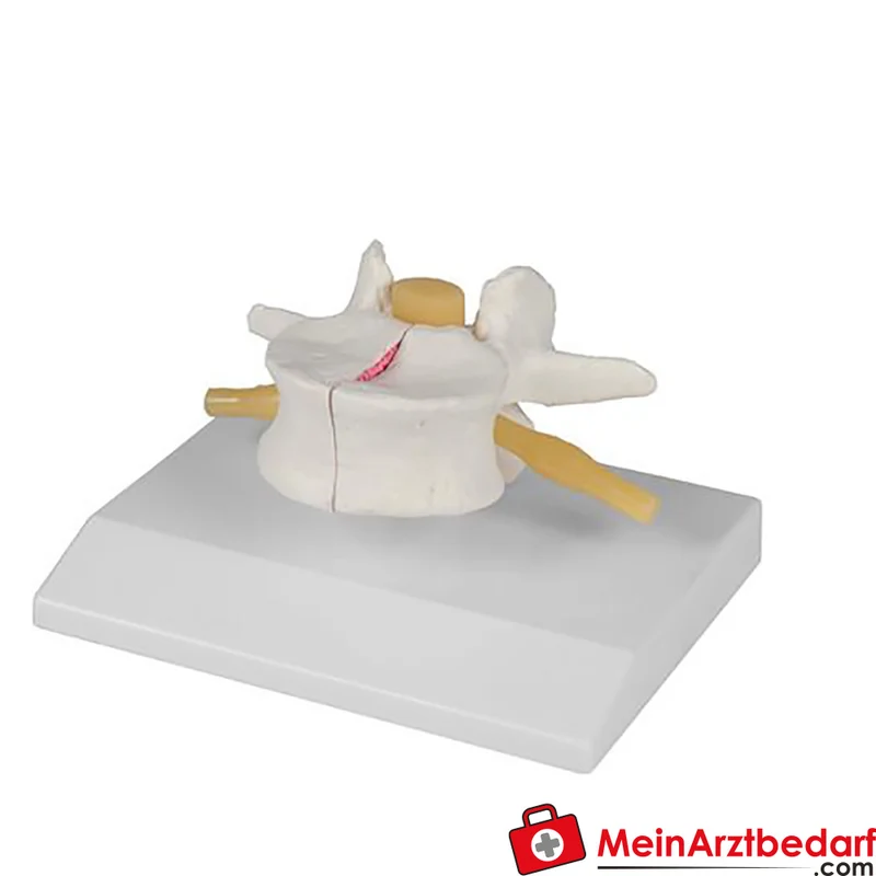 Erler-Zimmer Lendenwirbel-Modell Osteoporose 3-teilig magnetisch abnehmbar 16 cm