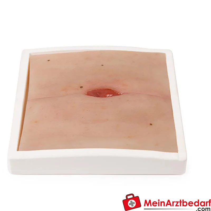 Erler-Zimmer Wundmoulage Ileostoma/Kolostoma Lehrmodell mit Stativ, herausnehmbar