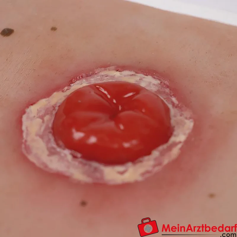Erler-Zimmer Wundmoulage Ileostoma/Kolostoma Lehrmodell mit Stativ, herausnehmbar