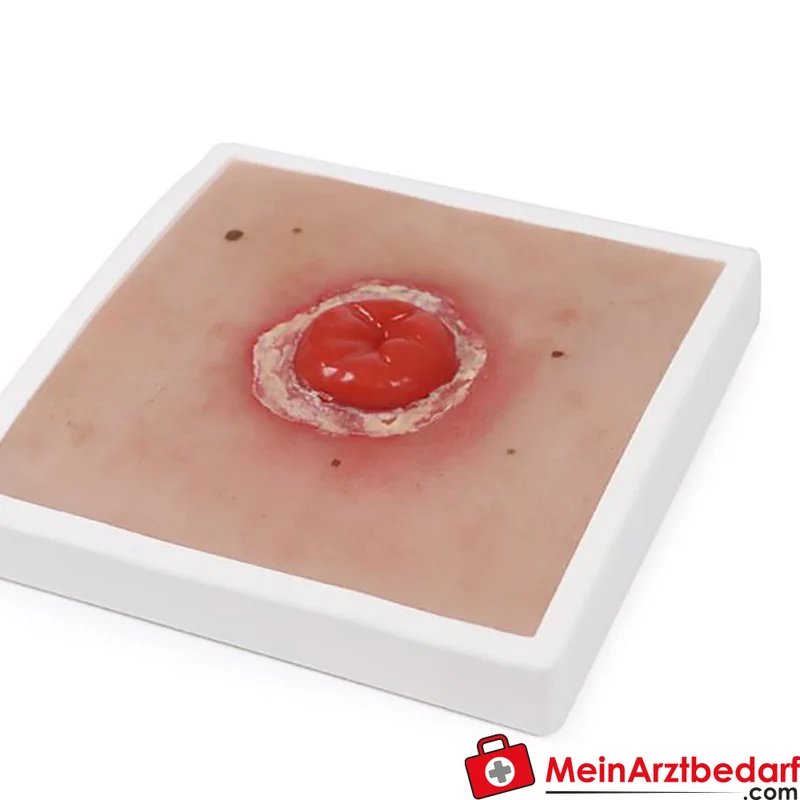Erler-Zimmer Wundmoulage Ileostoma/Kolostoma Lehrmodell mit Stativ, herausnehmbar