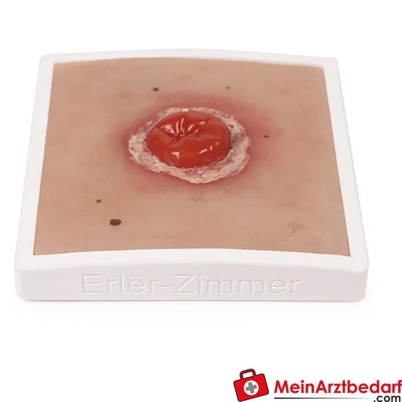 Erler-Zimmer Wundmoulage Ileostoma/Kolostoma Lehrmodell mit Stativ, herausnehmbar