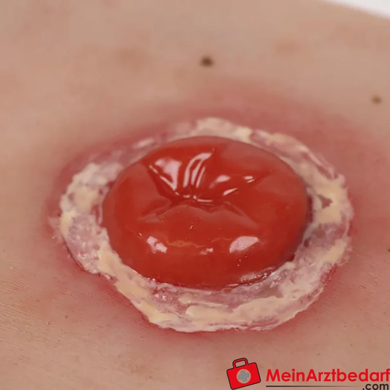Erler-Zimmer Wundmoulage Ileostoma/Kolostoma Lehrmodell mit Stativ, herausnehmbar