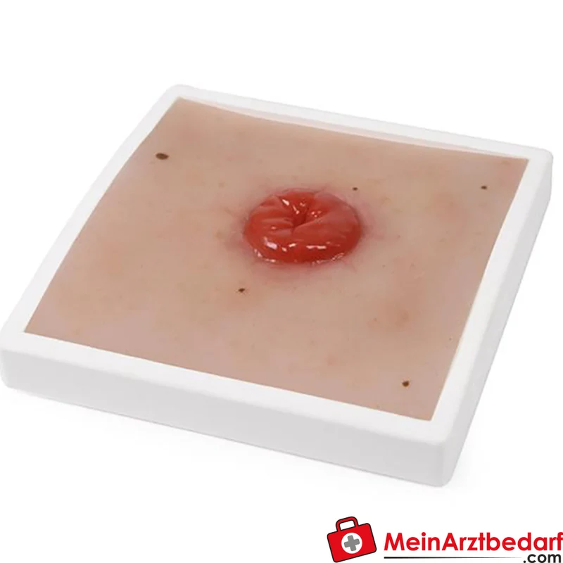 Erler-Zimmer Wundmoulage Ileostoma/Kolostoma Lehrmodell mit Stativ, herausnehmbar