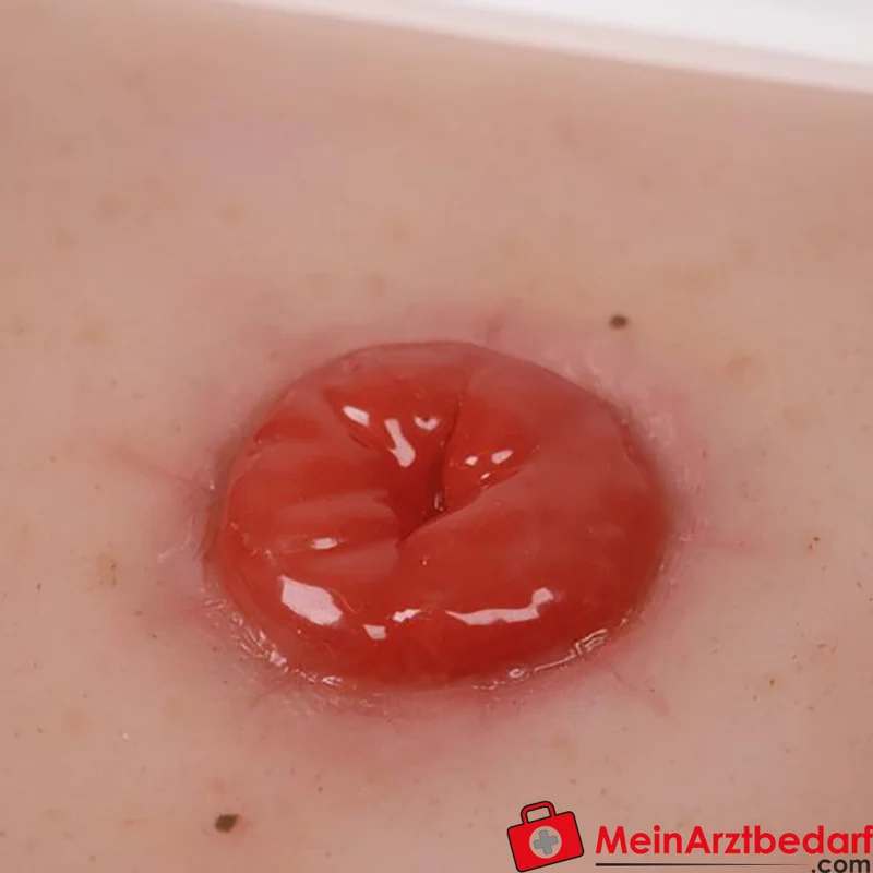 Erler-Zimmer Wundmoulage Ileostoma/Kolostoma Lehrmodell mit Stativ, herausnehmbar