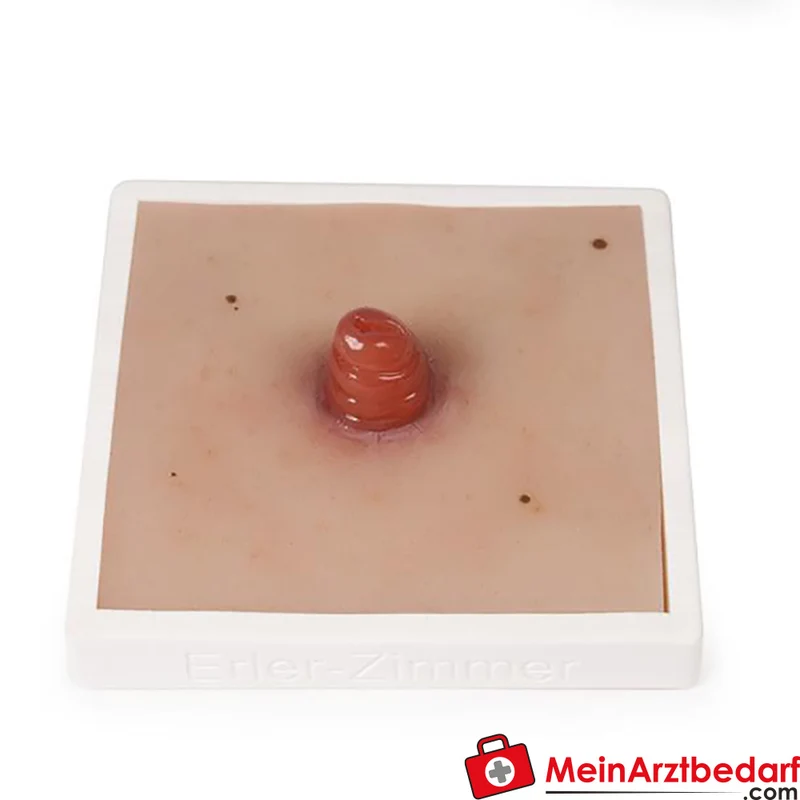 Erler-Zimmer Wundmoulage Ileostoma/Kolostoma Lehrmodell mit Stativ, herausnehmbar