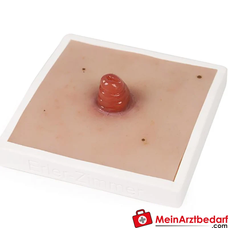 Erler-Zimmer Wundmoulage Ileostoma/Kolostoma Lehrmodell mit Stativ, herausnehmbar