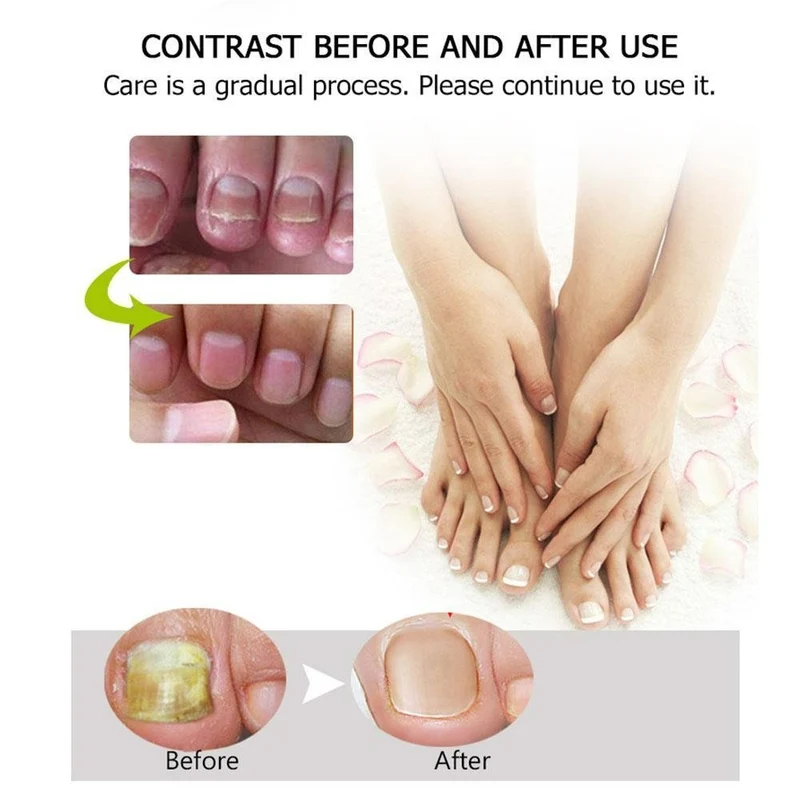 1+1 Gratis | Nagelreparatur | Schnelle und effektive Ergebnisse!