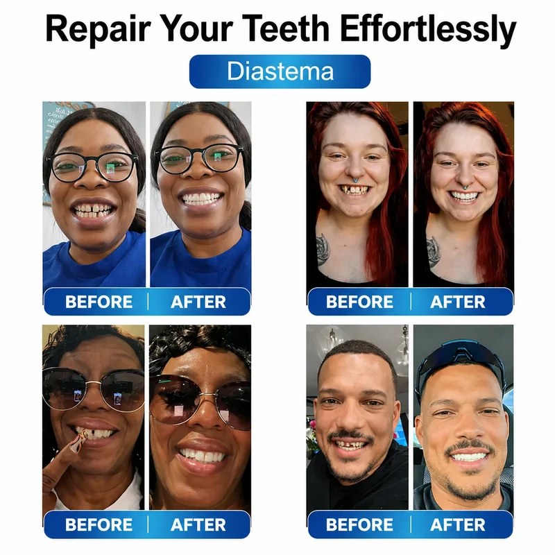 Prothesen | Zahnreparatur Set mit LED | Formbares Denture Gel | Futusly