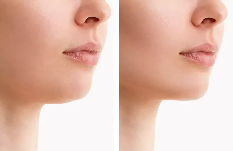 NovaLume ChinContour Rotlichttherapie-Gürtel für Doppelkinn