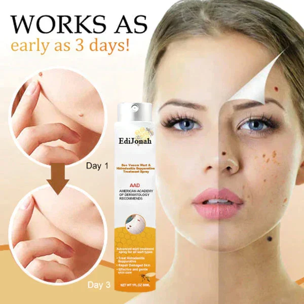 SkinClear | Warzenentferner Spray – Sanfte und Effektive Behandlung