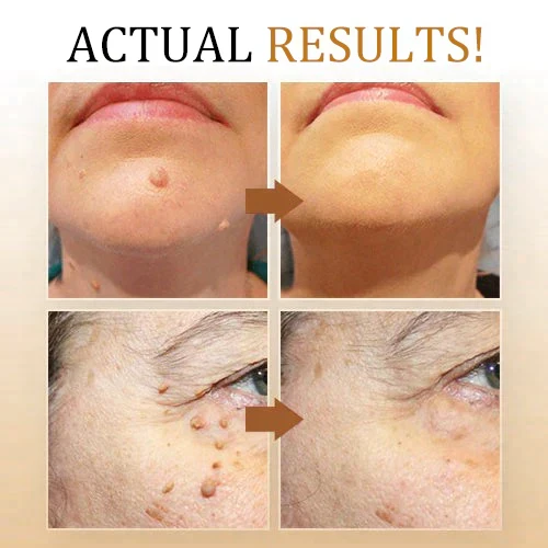 SkinClear | Warzenentferner Spray – Sanfte und Effektive Behandlung
