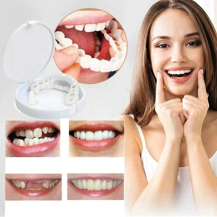 SmileSnap Sofort Veneer Kit für ästhetische Zahnverblendungen