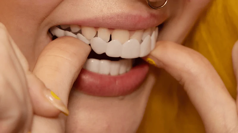 SmileSnap Sofort Veneer Kit für ästhetische Zahnverblendungen