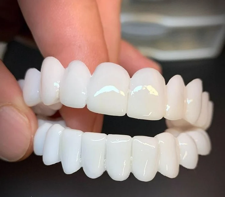 Zahnverblendungen DentAlign – Natürliche Anpassung und Komfort