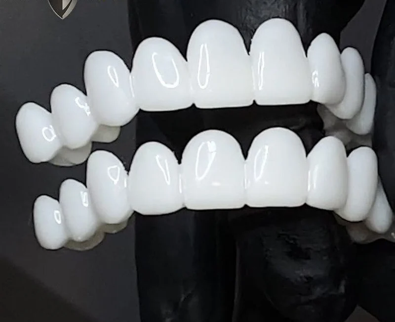 Zahnverblendungen DentAlign – Natürliche Anpassung und Komfort