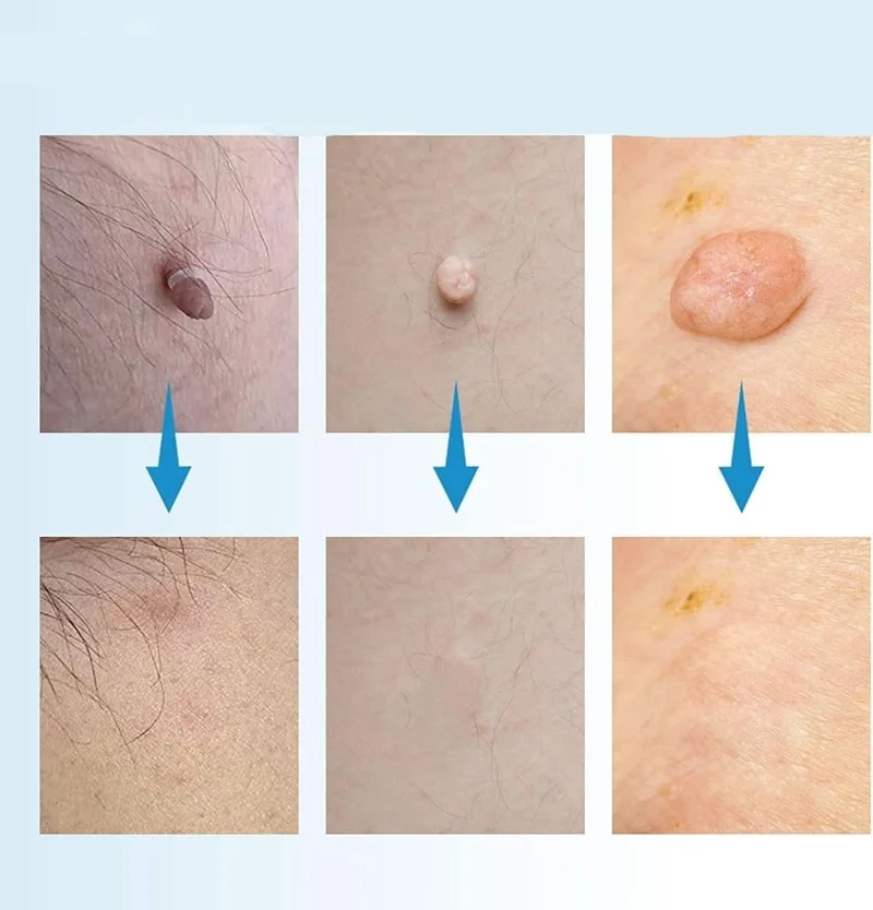 Dermaswift – Hautfleckenentferner Gegen Warzen Und Hautanhänger