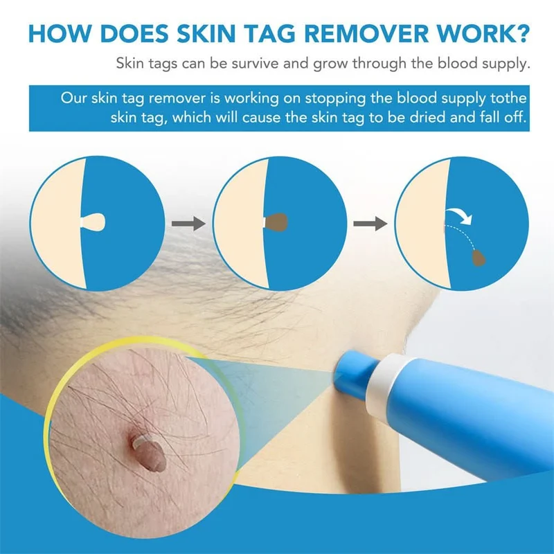 Dermaswift – Hautfleckenentferner Gegen Warzen Und Hautanhänger