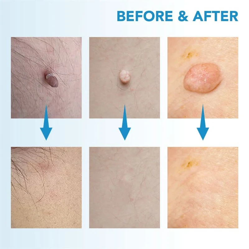 Dermaswift – Hautfleckenentferner Gegen Warzen Und Hautanhänger