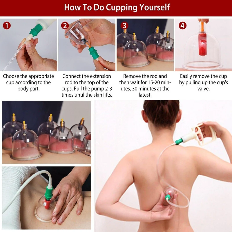 CuppingThera Pro | 32-teiliges Vakuum-Schröpfsatz für Massage & Akupunktur