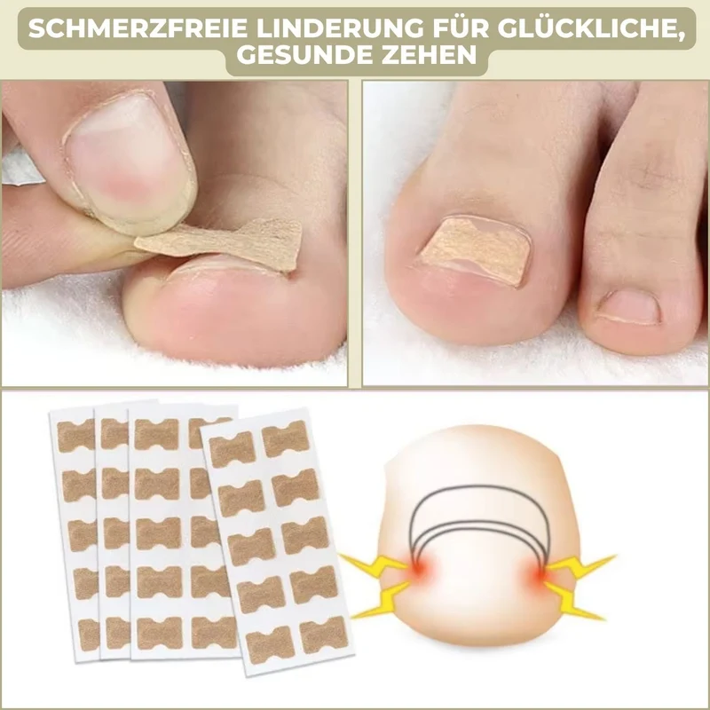 10+10 GRATIS | FixaNail - Direkte Nagelreparatur