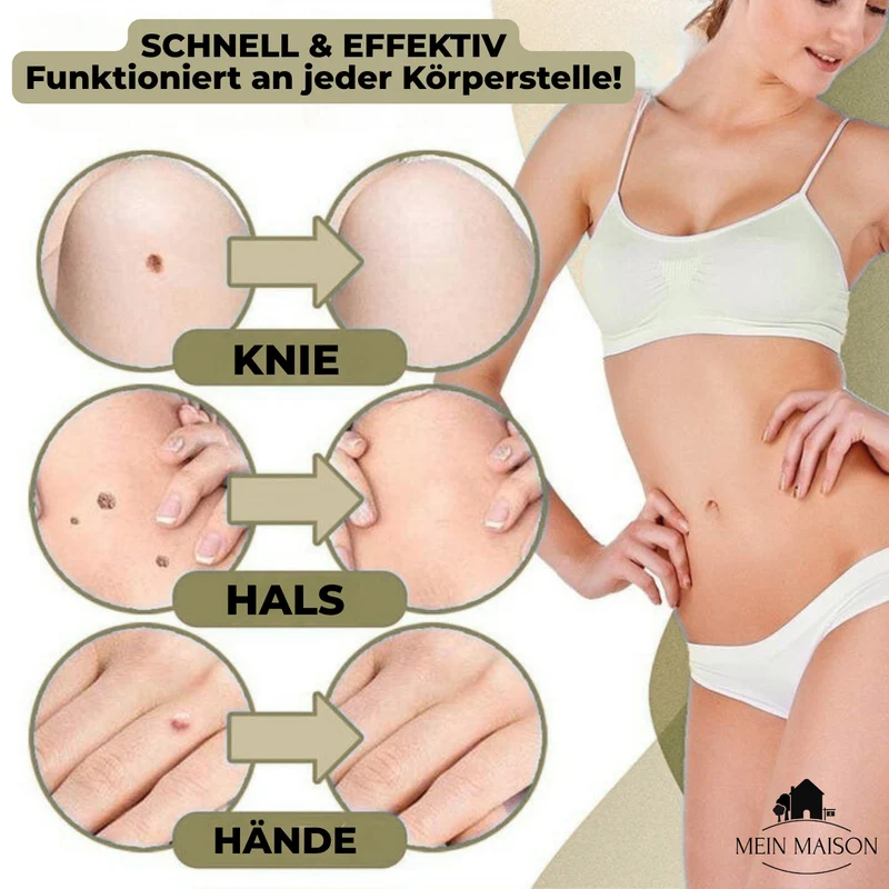 DermaLinx Warzenentferner | Schmerzfreie Entfernung von Warzen & Muttermalen | Für zu Hause | Ohne Operation