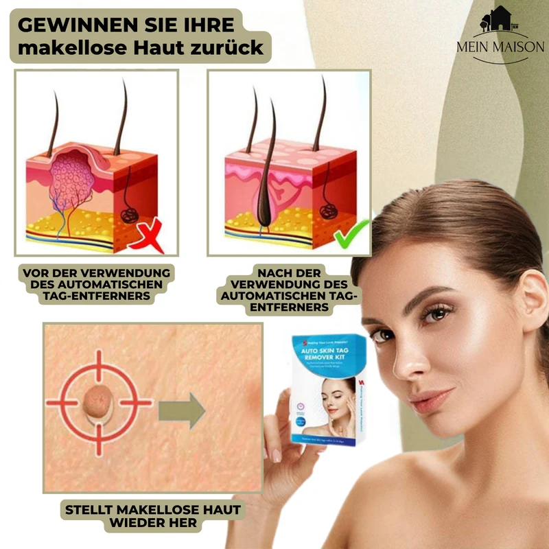 DermaLinx Warzenentferner | Schmerzfreie Entfernung von Warzen & Muttermalen | Für zu Hause | Ohne Operation