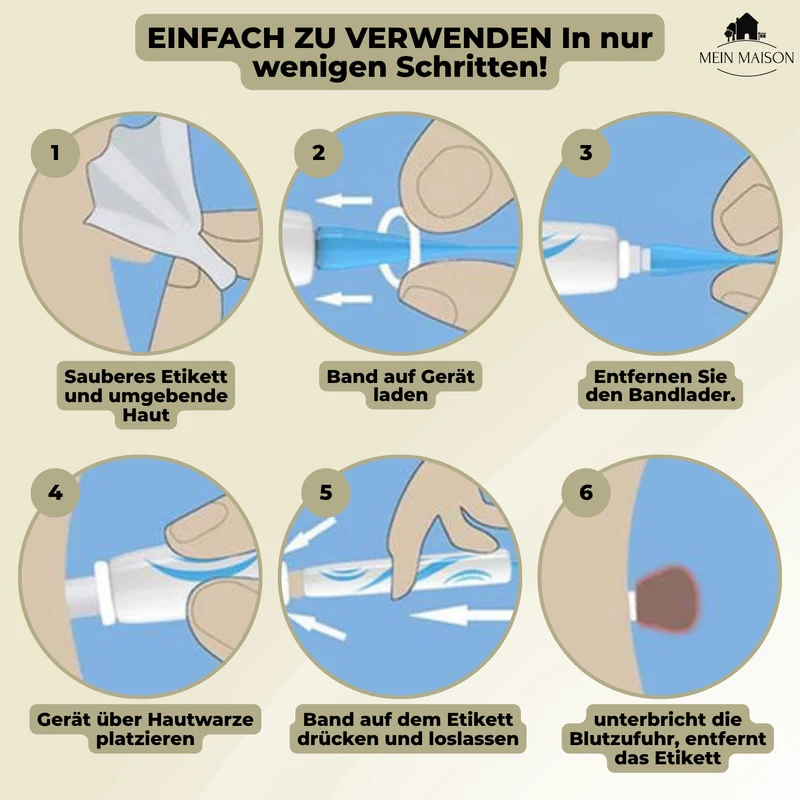 DermaLinx Warzenentferner | Schmerzfreie Entfernung von Warzen & Muttermalen | Für zu Hause | Ohne Operation